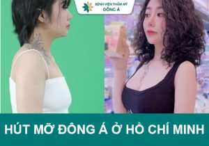 Hút mỡ Đông Á ở Hồ Chí Minh – Lấy lại vóc dáng cuốn hút, gợi cảm