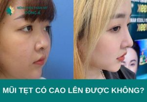 Mũi tẹt có cao lên được không? 3 bí kíp vuốt mũi tẹt thành mũi cao