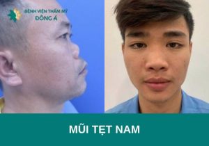 Mũi tẹt nam là gì? Phân tích tướng mũi tẹt theo nhân tướng học 