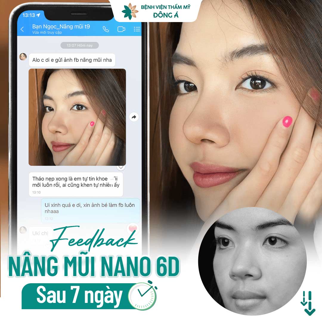 Feedback nâng mũi Nano sau 7 ngày khách hàng tại Đông Á