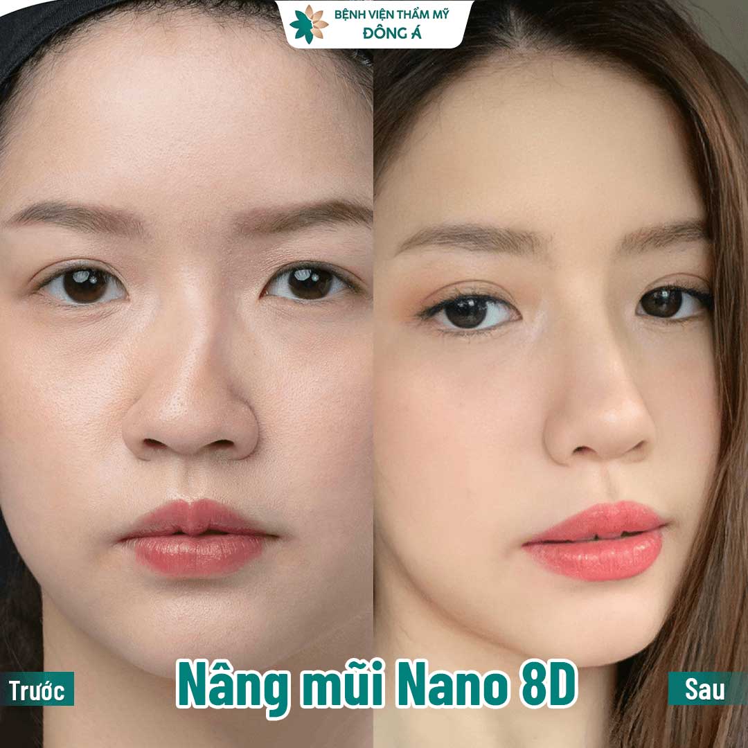 Hình ảnh khách hàng nâng mũi Nano 8D tại Đông Á