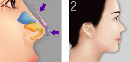Nâng mũi sụn tự thân và sụn nhân tạo