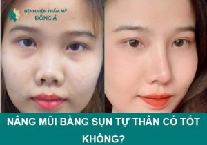 Nâng mũi bằng sụn tự thân có tốt không? Có an toàn không