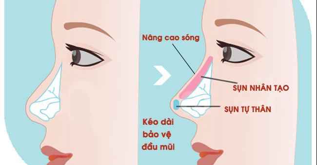 Nâng mũi bằng sụn tự thân có tốt không