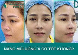 Nâng mũi Đông Á có tốt không? Ý kiến của chuyên gia