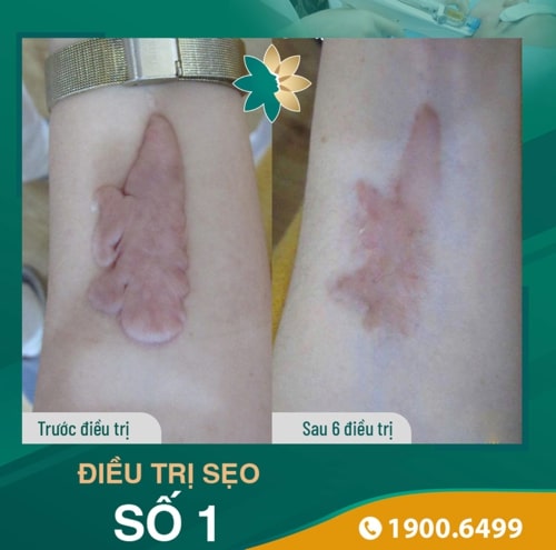 Sẹo kích thước lớn được khắc phục lên đến 98%