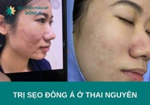 Trị sẹo Đông Á ở Thái Nguyên – Top địa chỉ trị sẹo uy tín nhất