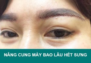 Nâng cung mày bao lâu hết sưng – bí quyết giúp nâng cung mày nhanh lành.
