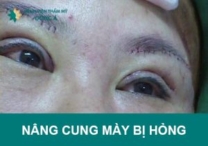 Nguyên nhân nâng cung mày bị hỏng và Cách khắc phục hiệu quả.
