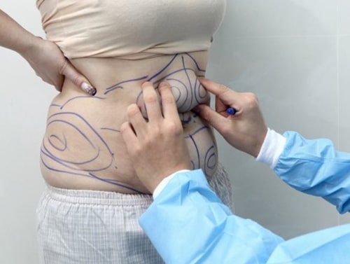 Xác định vị trí và khối lượng mỡ cần loại bỏ
