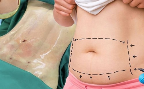 Hút mỡ bụng Body Jet là gì?