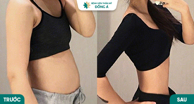 Lấy lại vóc dáng thon gọn chỉ sau 1 lần hút mỡ bụng