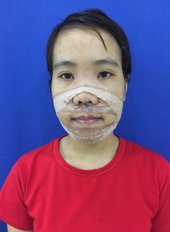 Kim Nhung những ngày đầu sau phẫu thuật