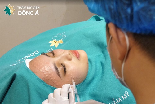 Kỹ thuật tiêm vi điểm